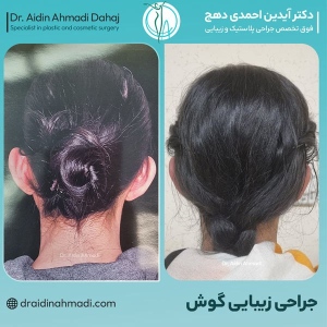 otoplasty-1