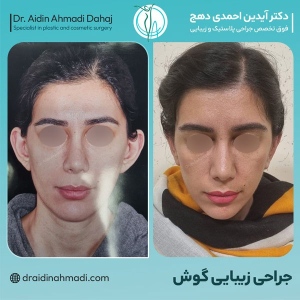 otoplasty-2