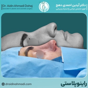 rhinoplasty-24