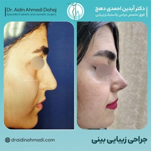 rhinoplasty-25