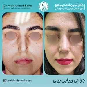 rhinoplasty-26