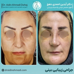 rhinoplasty-27