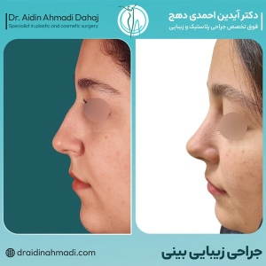 rhinoplasty-29