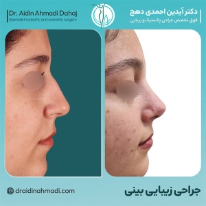 rhinoplasty-30