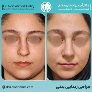 rhinoplasty-31