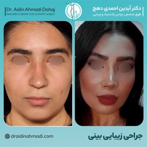 rhinoplasty-32
