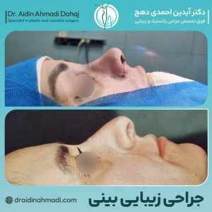 rhinoplasty-33