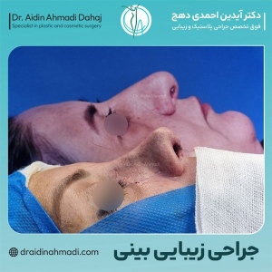 rhinoplasty-34