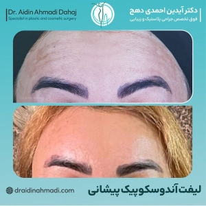 Endoscopic-forehead-lift-1