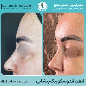 Endoscopic-forehead-lift-2