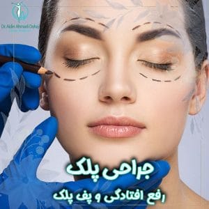 جراحی پلک - دکتر آیدین احمدی