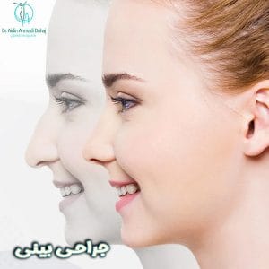 جراحی بینی - دکتر آیدین احمدی