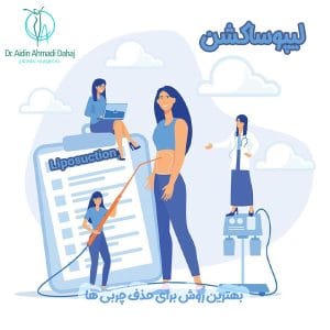 لیپوساکشن - دکتر آیدین احمدی دهج