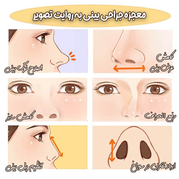 معجزه جراحی بینی - دکتر ایدین احمدی دهج