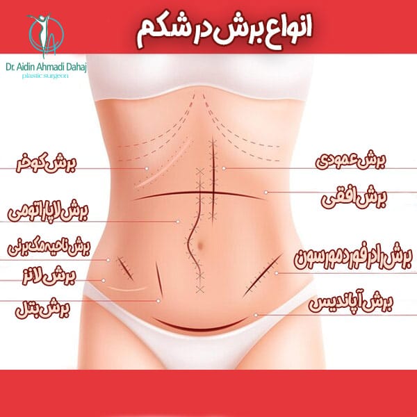 انواع برش در شکم - دکتر ایدین احمدی