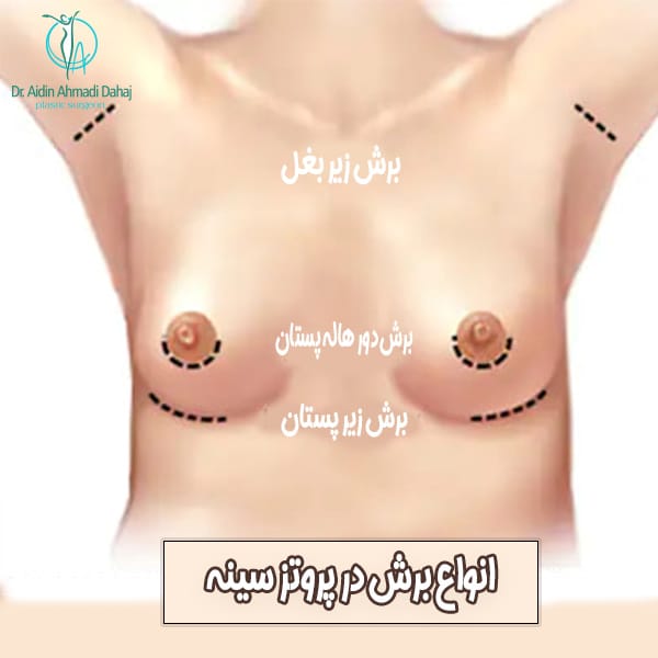 پروتز سینه-دکتر ایدین احمدی دهج