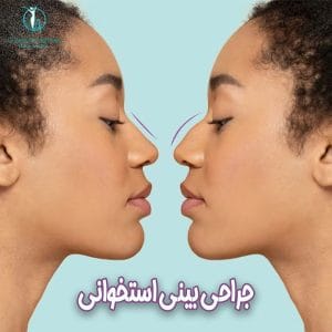 جراحی بینی استخوانی _ دکتر آیدین احمدی دهج