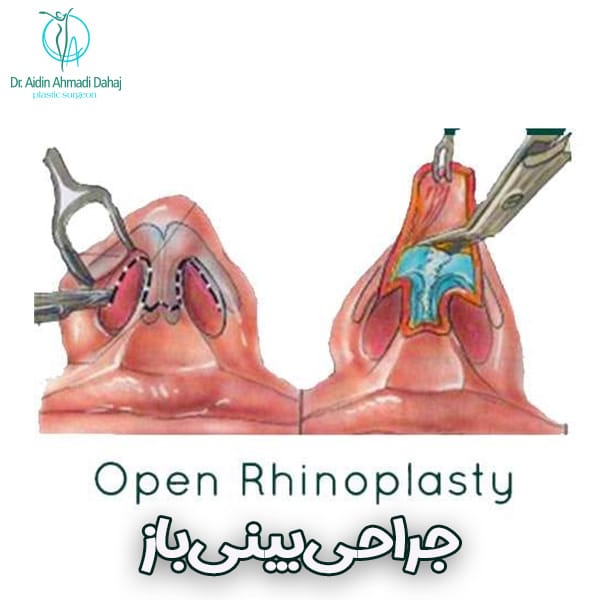 جراحی بینی باز - دکتر آیدین احمدی دهج