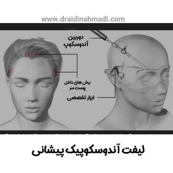 لیفت آندوسکوپیک پیشانی - https://draidinahmadi.com/