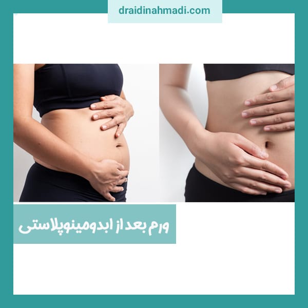 ورم بعد از ابدومینوپلاستی - https://draidinahmadi.com/