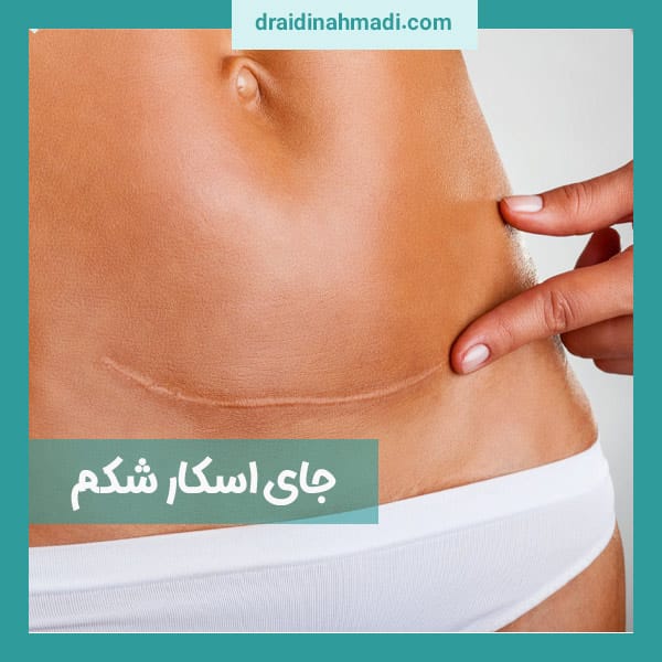 عکس جای بخیه شکم - https://draidinahmadi.com/