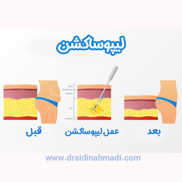 لیپوساکشن