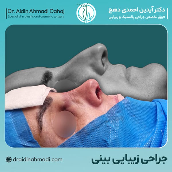 عکس نمونه کار جراحی بینی 