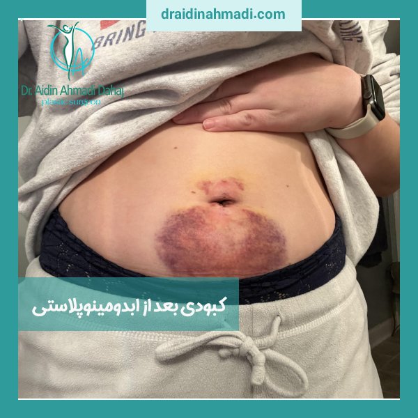 کبودی بعد از ابدومینوپلاستی