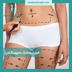 فرق لیپوماتیک با لیپوساکشن
