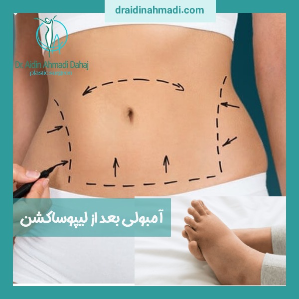 آمبولی بعد از لیپوساکشن