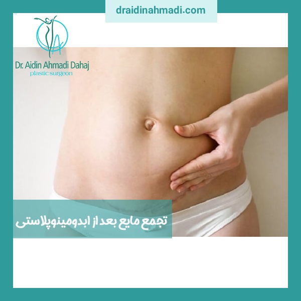 تجمع مایع بعد از ابدومینوپلاستی