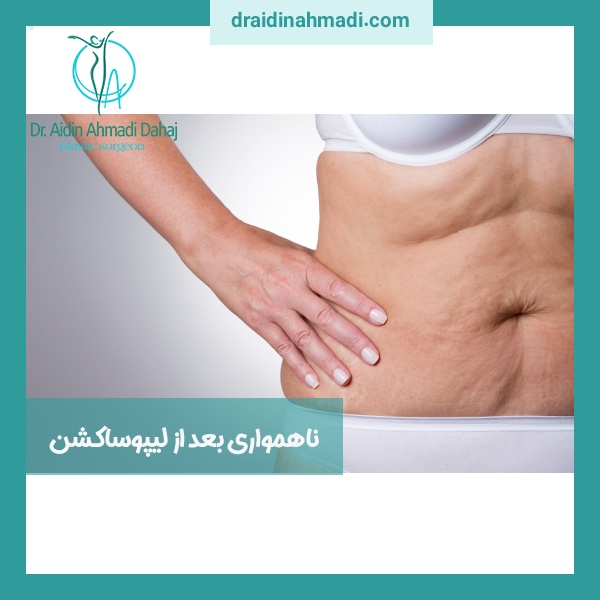 ناهمواری بعد از لیپوساکشن