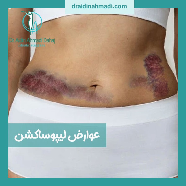 عوارض لیپوساکشن