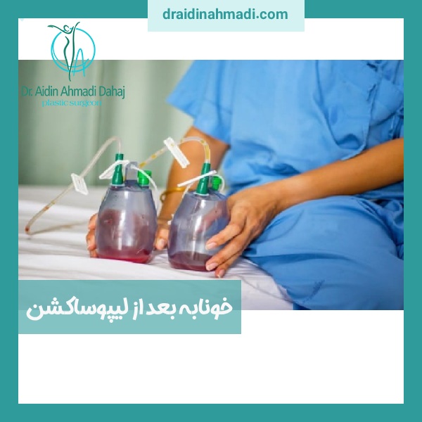 خونابه بعد از لیپوساکشن