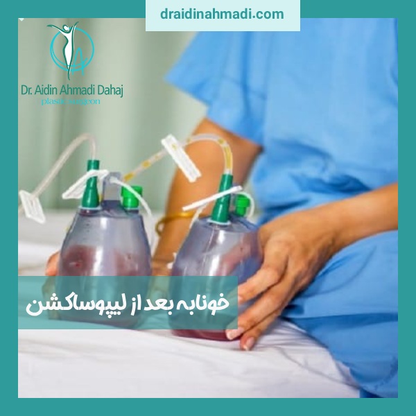 خونابه بعد از لیپوساکشن