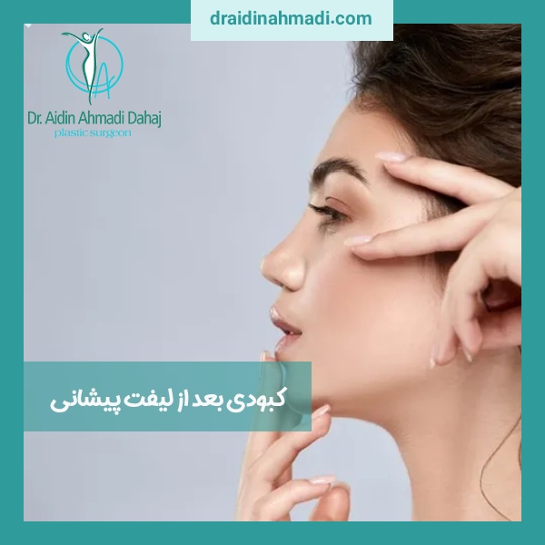 کبودی بعد از لیفت پیشانی