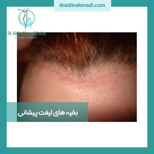بخیه های لیفت پیشانی