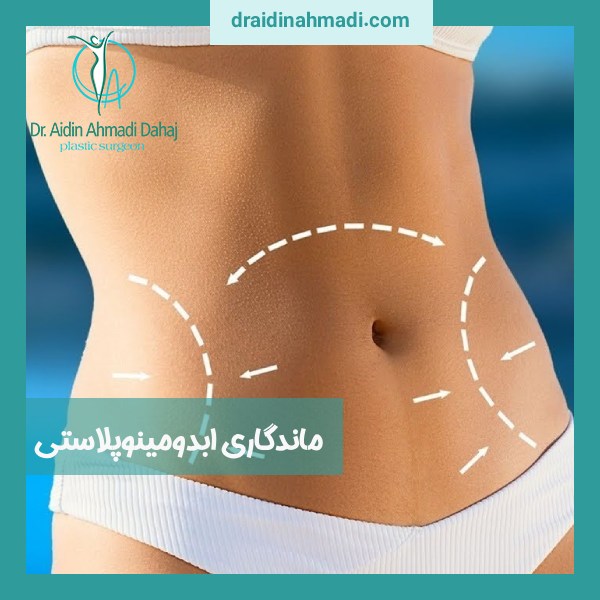 ماندگاری ابدومینوپلاستی