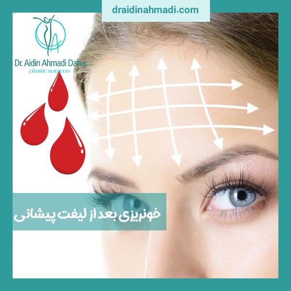خونریزی بعد از لیفت پیشانی