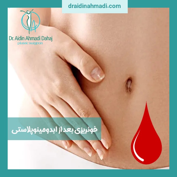 خونریزی بعد از ابدومینوپلاستی